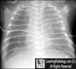 Hypolastic L Heart Syndrome